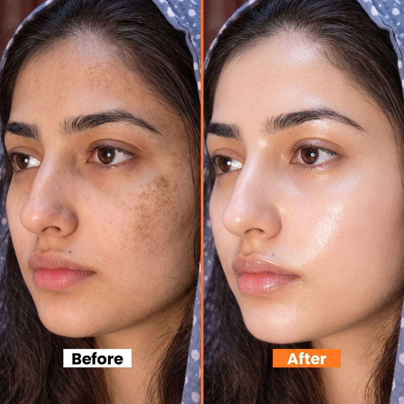 Acne & Oil Control