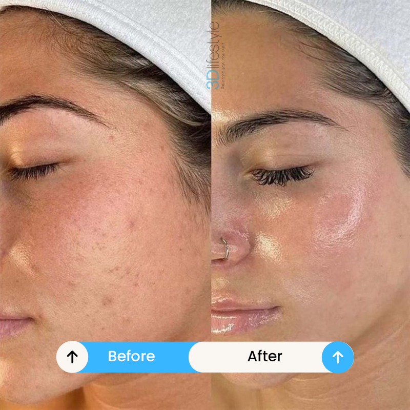 Acne & Oil Control