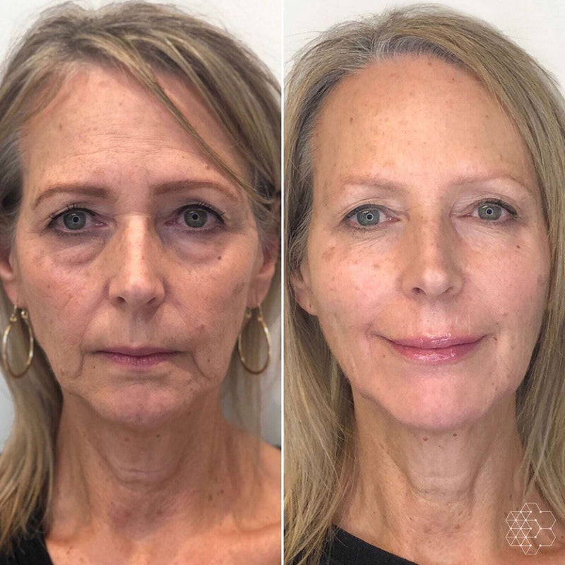 Anti-Aging